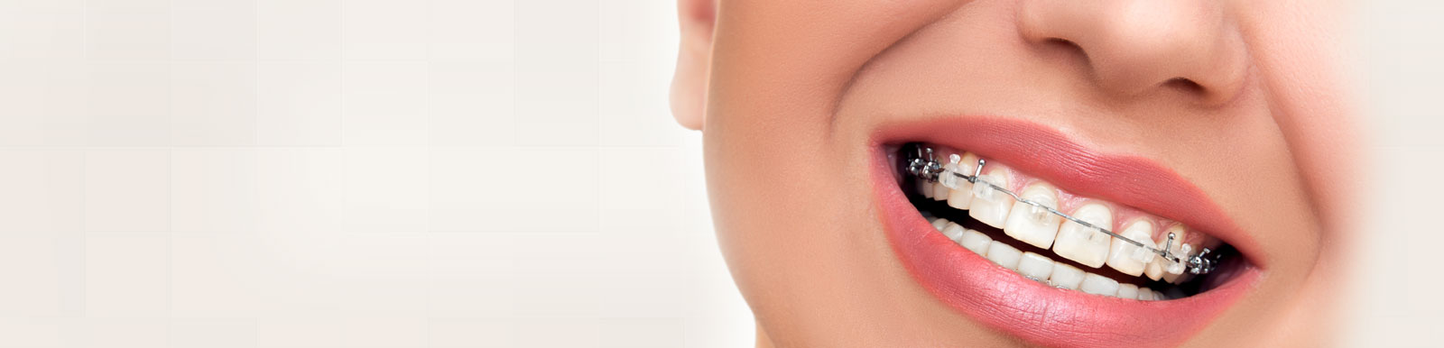 Redwood City Ceramic Braces