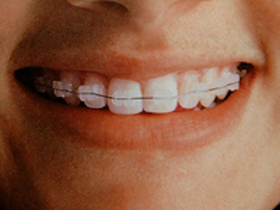Redwood City Ceramic Braces