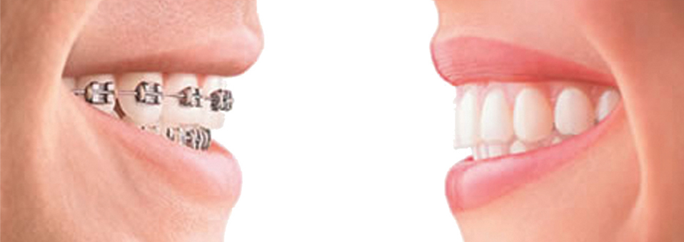 Different Type of Braces Different Type of Braces