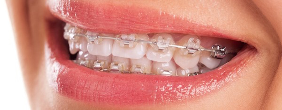 Redwood City Ceramic Braces Redwood City Ceramic Braces