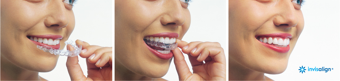 Redwood City Invisalign Services Redwood City Invisalign Services