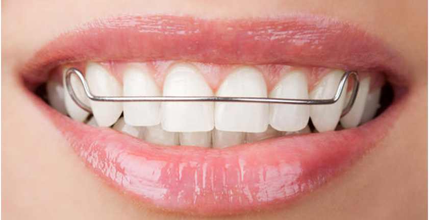 Dental Retainer Services In Redwood City 94062 Dental Retainer Services In Redwood City 94062